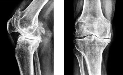 Gonarthrose des Kniegelenks im Röntgenbild