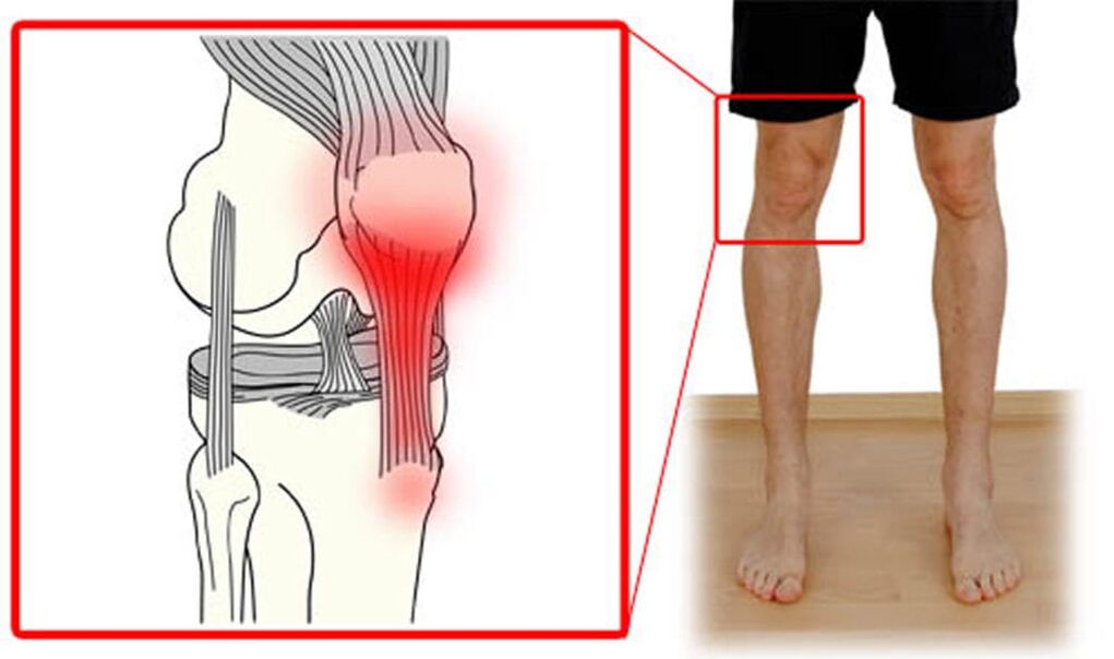 Tendinitis – Entzündung der Sehnen des Kniegelenks