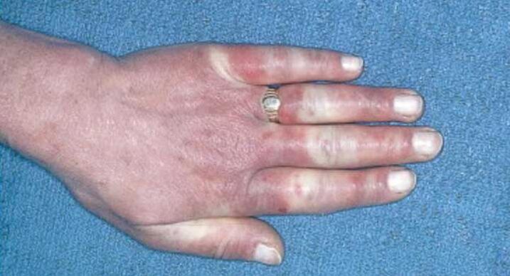 Klinisches Bild des Raynaud-Syndroms, Vasospasmus, Hyperämie, Ödem